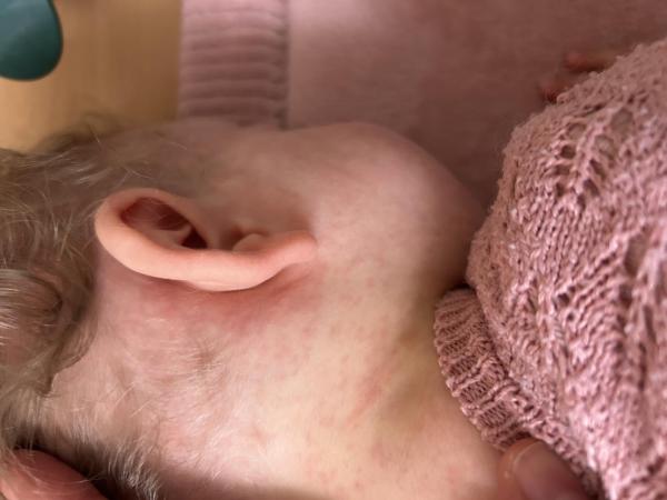 Bild zu Masern oder etwas anderes? - Haut von Babys und Kindern ✔️ Expertenforum