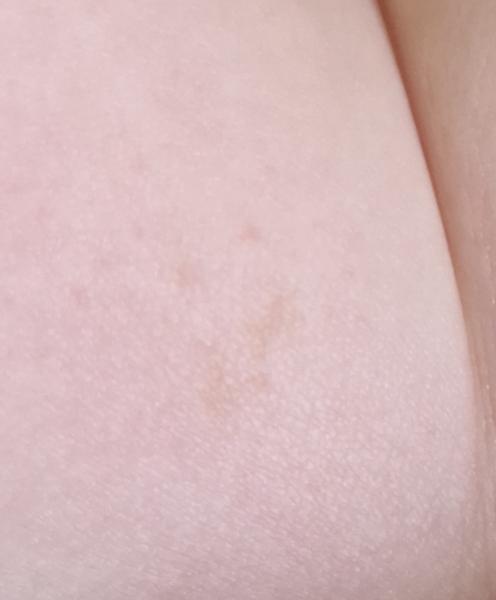 Bild zu Pigmentflecken bei Baby - Haut von Babys und Kindern ✔️ Expertenforum