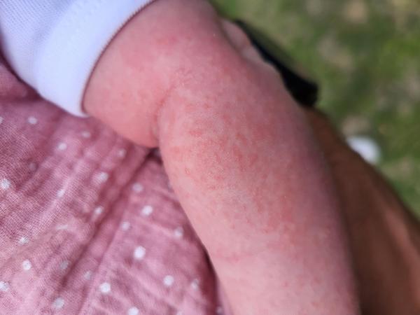 Bild zu Hautbefund Baby, 4 Wochen - Rückfrage - Haut von Babys und Kindern ✔️ Expertenforum