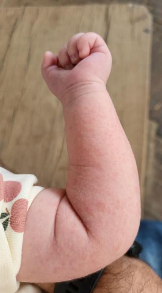 Bild zu Hautbefund Baby, 4 Wochen - Rückfrage - Haut von Babys und Kindern ✔️ Expertenforum