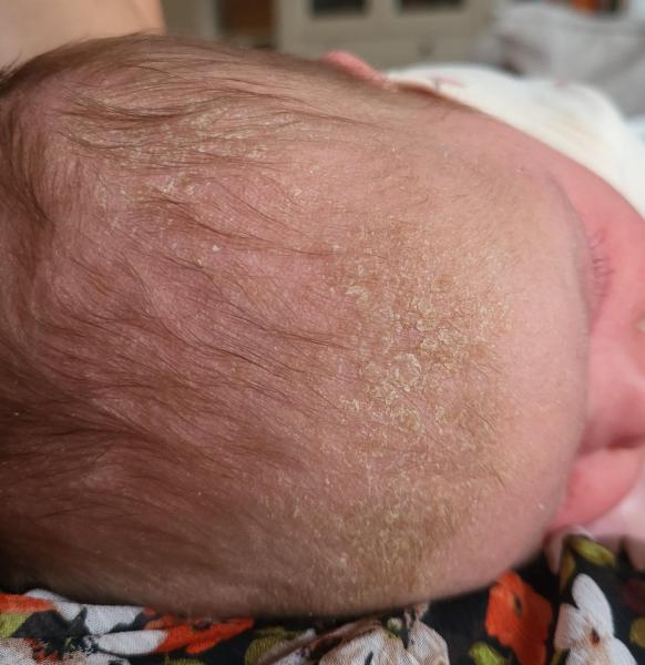 Bild zu Hautbefund Baby, 4 Wochen - Rückfrage - Haut von Babys und Kindern ✔️ Expertenforum