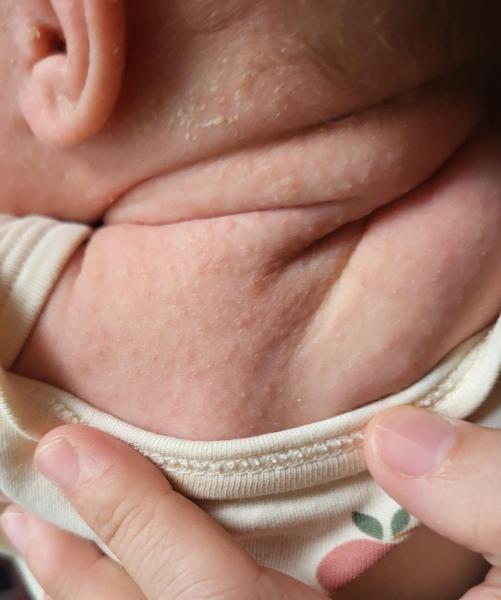 Bild zu Hautbefund Baby, 4 Wochen - Rückfrage - Haut von Babys und Kindern ✔️ Expertenforum