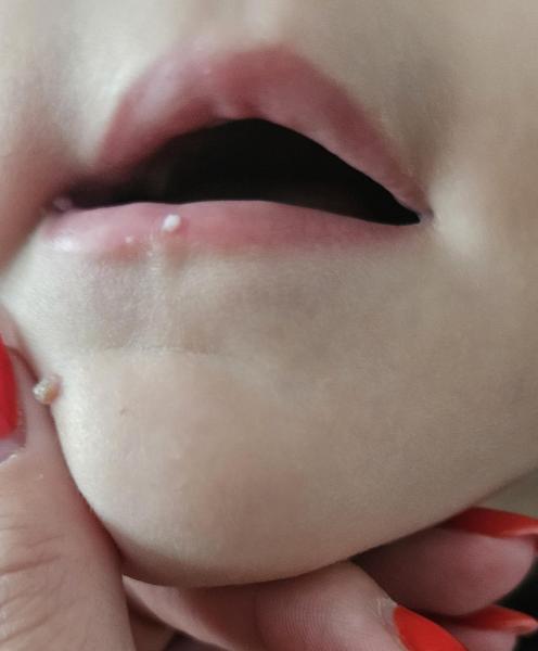 Bild zu Warzen - Haut von Babys und Kindern ✔️ Expertenforum