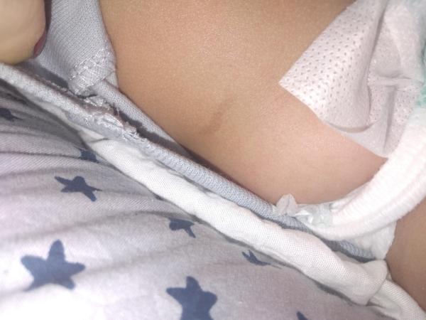 Bild zu Baby 4 Monate Fleck am Bauch - Haut von Babys und Kindern ✔️ Expertenforum