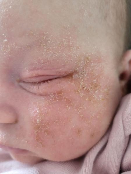 Bild zu Hautbefund Baby, 4 Wochen - Haut von Babys und Kindern ✔️ Expertenforum