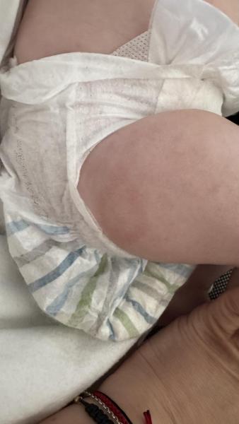 Bild zu Einzelner Runder Ausschlag - Haut von Babys und Kindern ✔️ Expertenforum