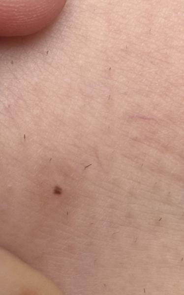 Bild zu Leberfleck weggekratzt nachgewachsen - Haut von Babys und Kindern ✔️ Expertenforum