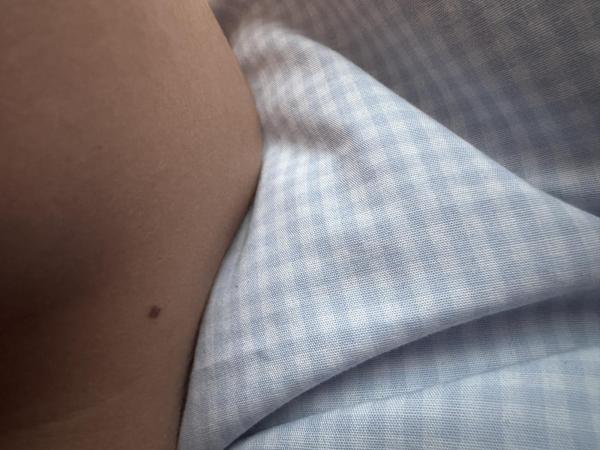 Bild zu Muttermal entsteht und wächst schnell bei Kind - Haut von Babys und Kindern ✔️ Expertenforum