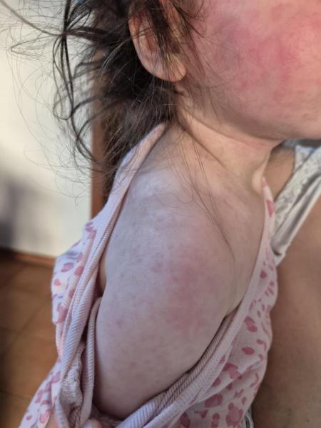 Bild zu ACWY Impfung (Nimenrix), Fieber-Exanthem bzw. Exantheme subitum - Haut von Babys und Kindern ✔️ Expertenforum