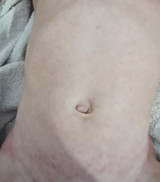 Bild zu ACWY Impfung (Nimenrix), Fieber-Exanthem bzw. Exantheme subitum - Haut von Babys und Kindern ✔️ Expertenforum