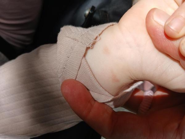 Bild zu Dunkle Flecken - Haut von Babys und Kindern ✔️ Expertenforum