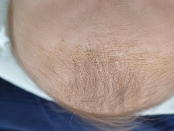 Bild zu Anliegen - Haut von Babys und Kindern ✔️ Expertenforum