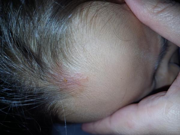 Bild zu Stich - Haut von Babys und Kindern ✔️ Expertenforum