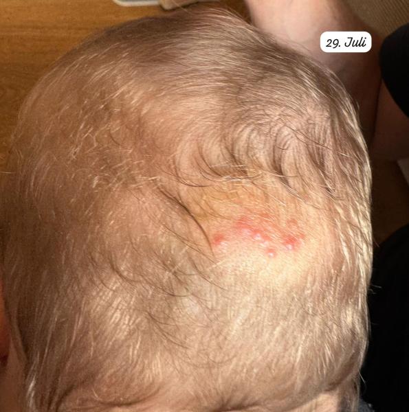 Bild zu Ausschlag am Hinterkopf - Haut von Babys und Kindern ✔️ Expertenforum
