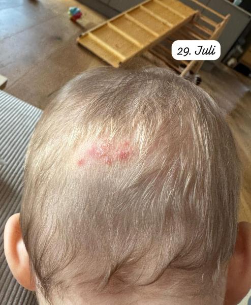 Bild zu Ausschlag am Hinterkopf - Haut von Babys und Kindern ✔️ Expertenforum