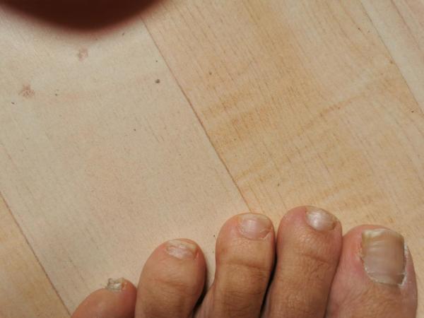 Bild zu Hefer-Nagelzehen-Pilze - Haut von Babys und Kindern ✔️ Expertenforum