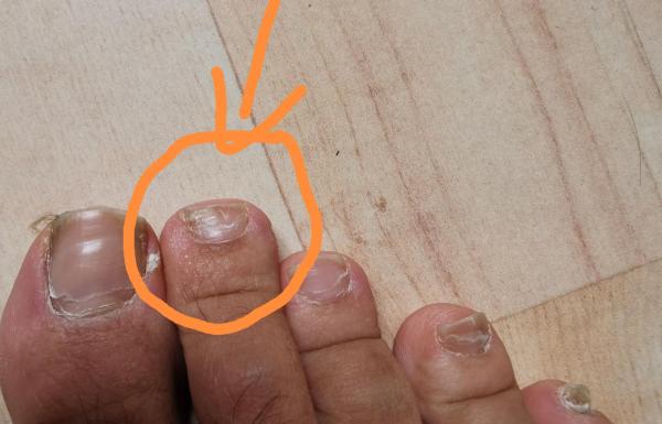 Bild zu Hefer-Nagelzehen-Pilze - Haut von Babys und Kindern ✔️ Expertenforum
