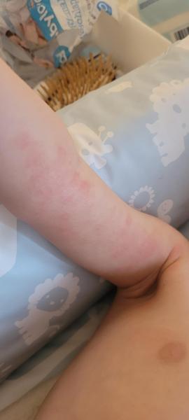 Bild zu Trockene Haut? Unverträglichkeit? Neurodermitis? - Haut von Babys und Kindern ✔️ Expertenforum