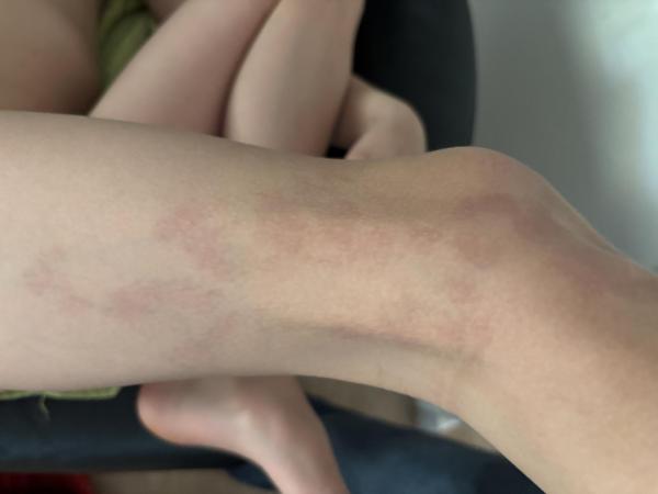 Bild zu Landkartenähnliche Flecken nach dem Baden - Haut von Babys und Kindern ✔️ Expertenforum
