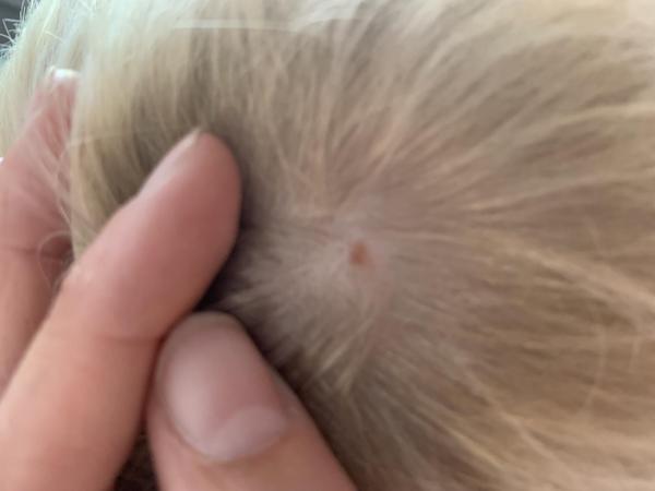 Bild zu Fleck auf Kopfhaut - Haut von Babys und Kindern ✔️ Expertenforum