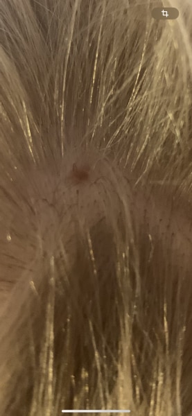 Bild zu Nochmal Fleck an Kopf - Haut von Babys und Kindern ✔️ Expertenforum