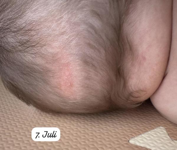 Bild zu Ausschlag am Hinterkopf - Haut von Babys und Kindern ✔️ Expertenforum