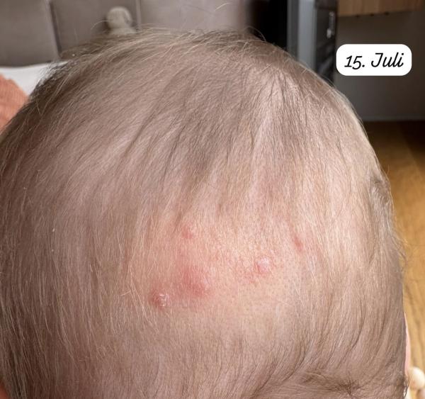Bild zu Ausschlag am Hinterkopf - Haut von Babys und Kindern ✔️ Expertenforum
