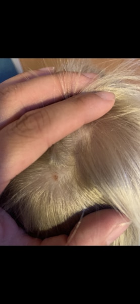 Bild zu Nochmal Fleck an Kopf - Haut von Babys und Kindern ✔️ Expertenforum