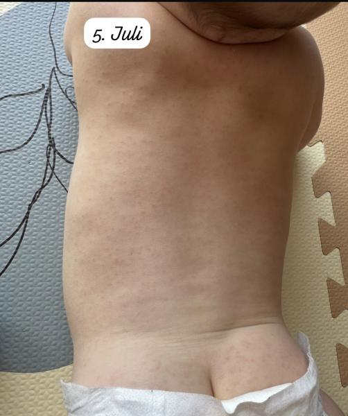 Bild zu Ausschlag am Hinterkopf - Haut von Babys und Kindern ✔️ Expertenforum