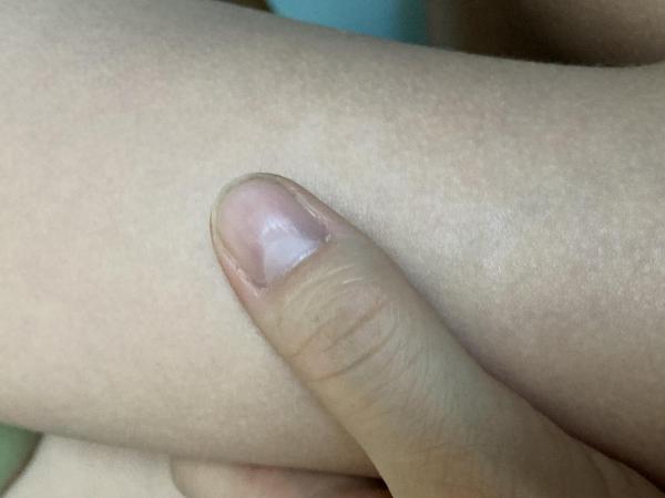 Bild zu Weisse Flecken am Oberschenkel - Haut von Babys und Kindern ✔️ Expertenforum