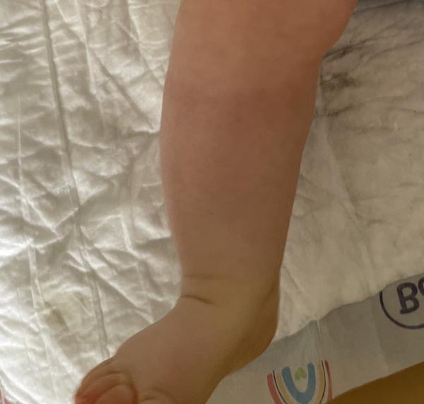 Bild zu Streifen unterhalb der Knie - Haut von Babys und Kindern ✔️ Expertenforum