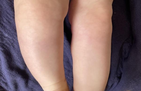 Bild zu Streifen unterhalb der Knie - Haut von Babys und Kindern ✔️ Expertenforum