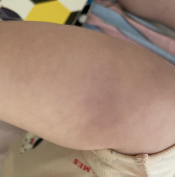 Bild zu Streifen unterhalb der Knie - Haut von Babys und Kindern ✔️ Expertenforum