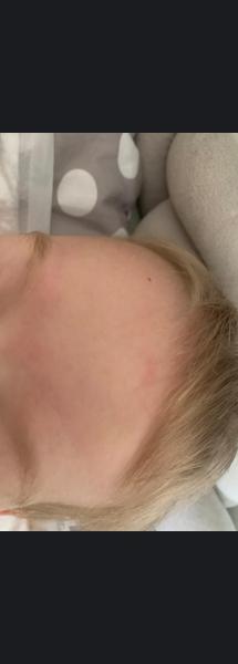 Bild zu Ausschlag/Abdruck/Streifen an der Stirn - Haut von Babys und Kindern ✔️ Expertenforum