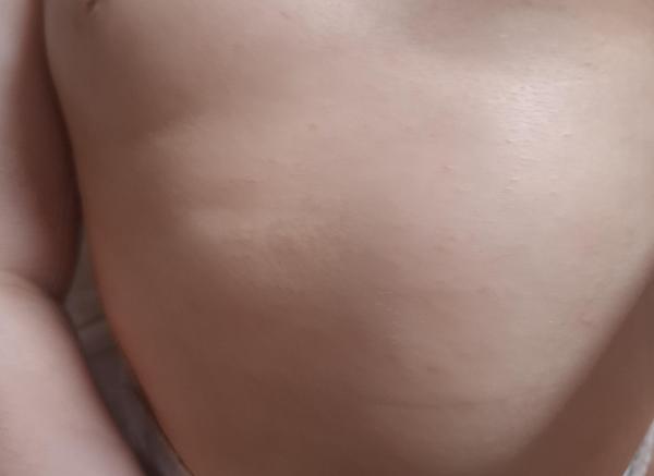 Bild zu Neurodermitis 10 Monate - Haut von Babys und Kindern ✔️ Expertenforum