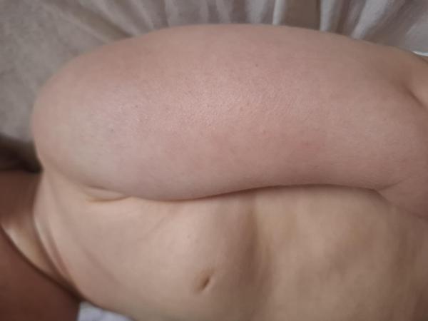 Bild zu Neurodermitis 10 Monate - Haut von Babys und Kindern ✔️ Expertenforum