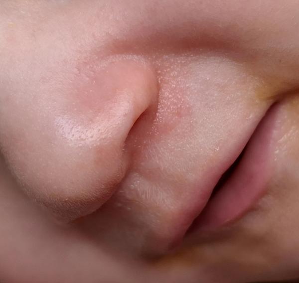 Bild zu Neurodermitis 10 Monate - Haut von Babys und Kindern ✔️ Expertenforum