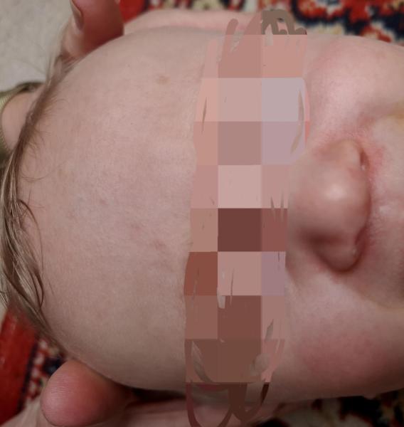Bild zu Neurodermitis 10 Monate - Haut von Babys und Kindern ✔️ Expertenforum