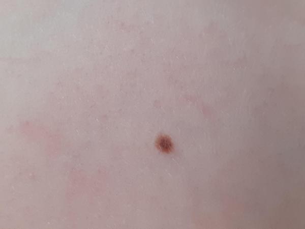 Bild zu Psoriasis - Haut von Babys und Kindern ✔️ Expertenforum