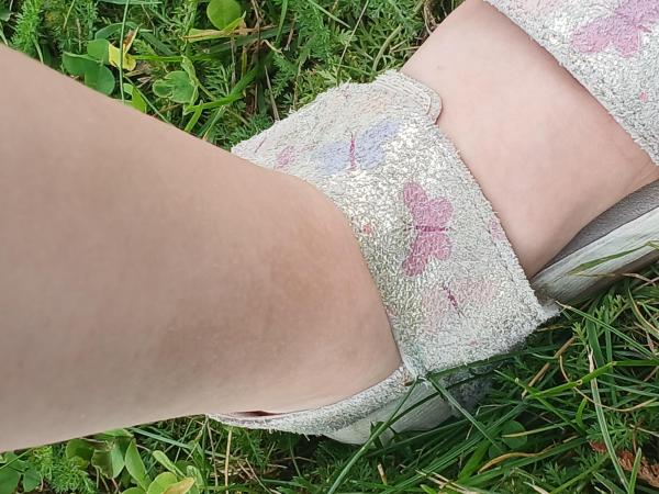 Bild zu Braune Stelle Vein - Haut von Babys und Kindern ✔️ Expertenforum