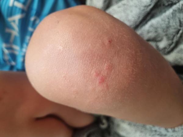 Bild zu Ausschlag am Knie - Haut von Babys und Kindern ✔️ Expertenforum