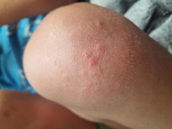 Bild zu Ausschlag am Knie - Haut von Babys und Kindern ✔️ Expertenforum