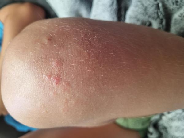 Bild zu Ausschlag am Knie - Haut von Babys und Kindern ✔️ Expertenforum