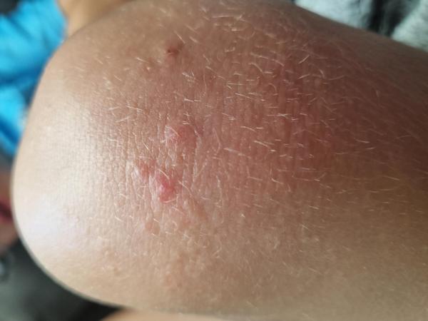 Bild zu Ausschlag am Knie - Haut von Babys und Kindern ✔️ Expertenforum