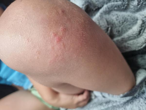 Bild zu Ausschlag am Knie - Haut von Babys und Kindern ✔️ Expertenforum