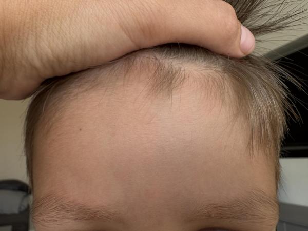 Bild zu Rote Äderchen im Gesicht - Haut von Babys und Kindern ✔️ Expertenforum