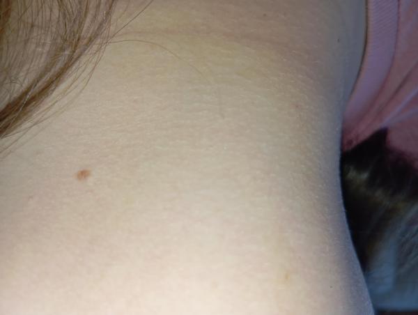 Bild zu Ist das Hautkrebs - Haut von Babys und Kindern ✔️ Expertenforum