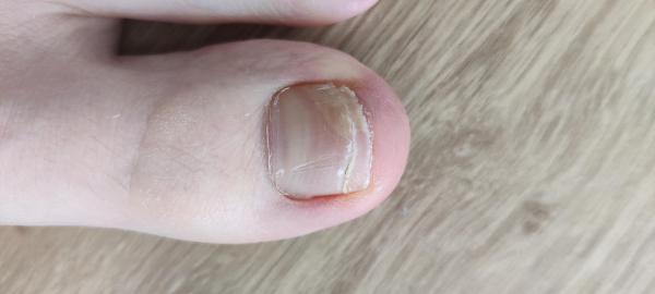 Bild zu Nochmal Nagelpilz - Haut von Babys und Kindern ✔️ Expertenforum