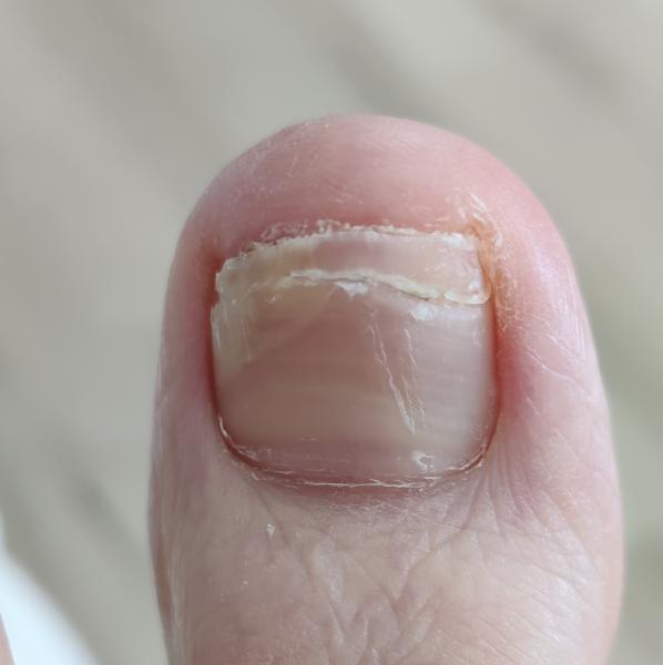 Bild zu Nagelpilz? - Haut von Babys und Kindern ✔️ Expertenforum