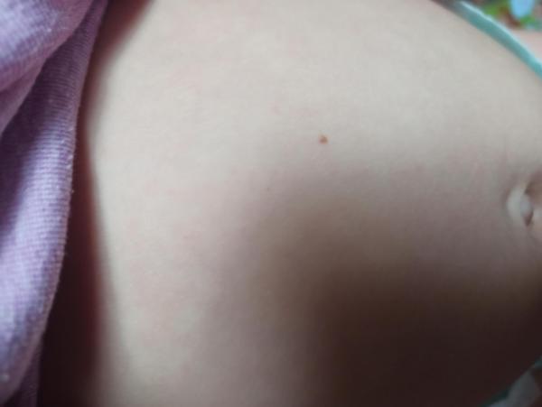 Bild zu Leber Fleck bei Kleinkind - Haut von Babys und Kindern ✔️ Expertenforum